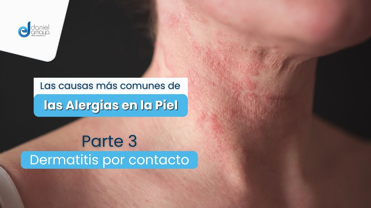 CAUSAS MÁS COMUNES DE ALERGIA EN LA PIEL | Dermatitis Alérgica por Contacto: PARTE 3