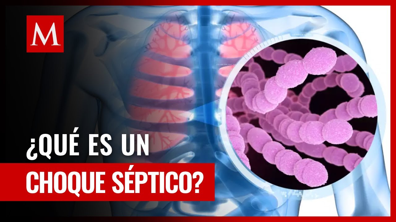 ¿Qué es choque séptico, la afección pone en riesgo tu vida?