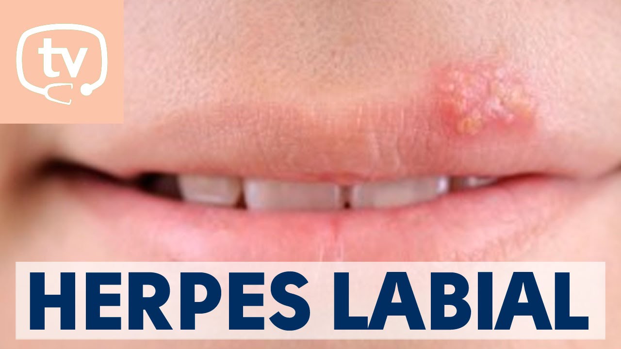 El herpes labial: qué es, causas y tratamiento