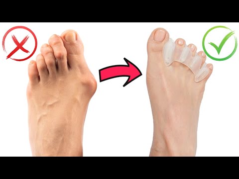 Build Healthy Feet - BEST TOE SPACERS