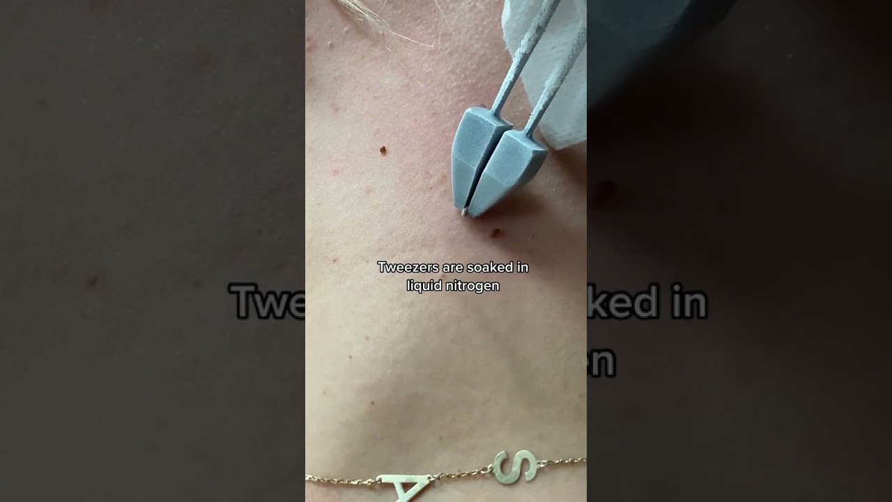 Doctors shows painless way to get rid of skin tags in the clinic | 208SkinDoc