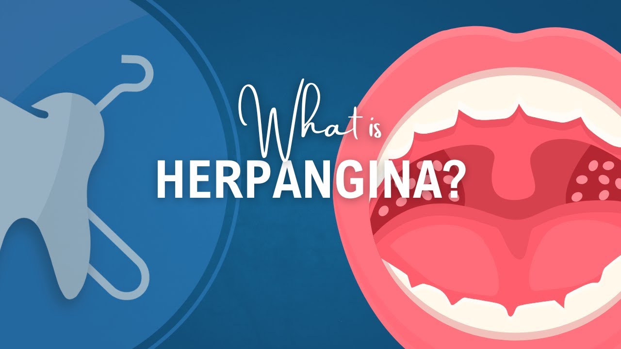 What is Herpangina? Signs, Diagnosis and Management
