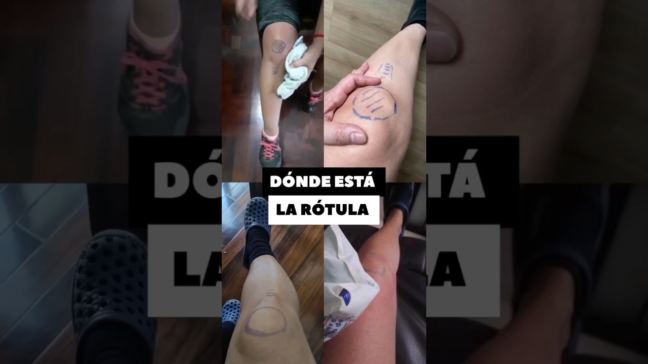 DÓNDE ESTÁ LA RÓTULA