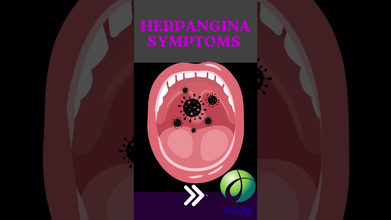 Herpangina Symptoms 😬 #shorts