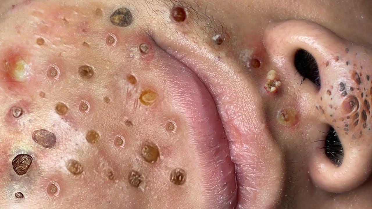 Loan Nguyen Acne Treatment 7q