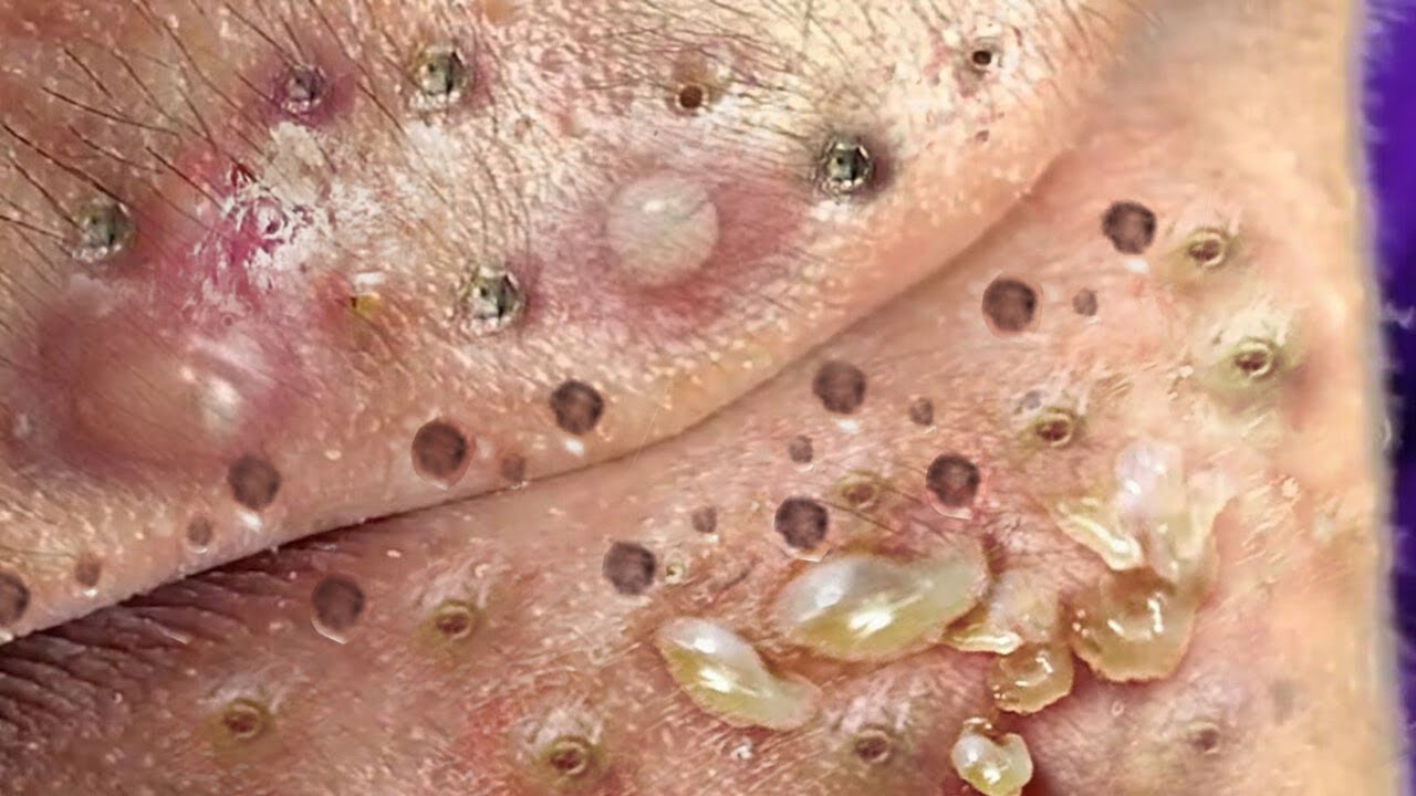 Loan Nguyen Acne Treatment 1276